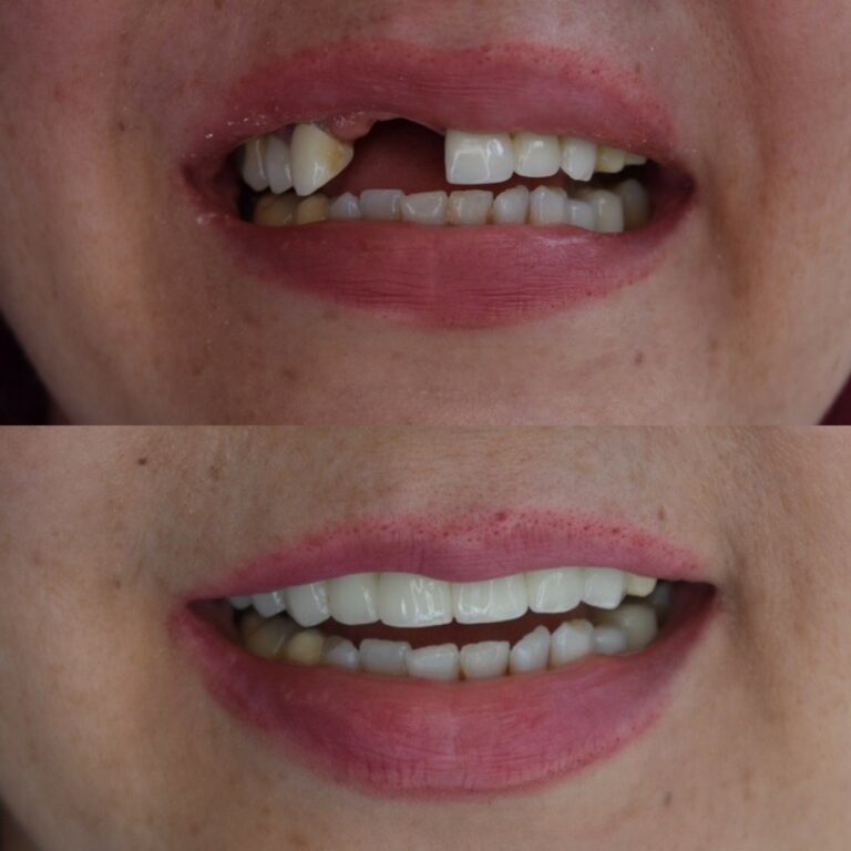 Before and After Bridge Procedure | Dr. Christian Chung, D.D.S.