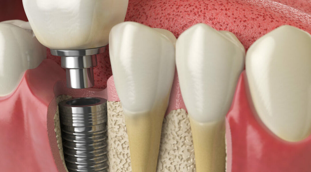 Dental Implants