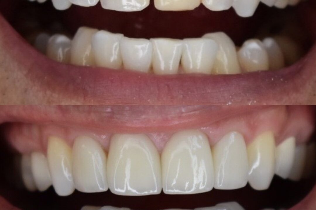 Veneers